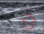 Implementing Ultrasound-Guided Intravenous Practices on a Multi-Service unit